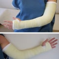 Understanding Bracing and Casting for Orthopedic Rehabilitation