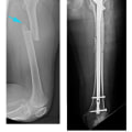 Fracture Repair Surgery: A Comprehensive Guide to Orthopedic Treatment and Rehabilitation
